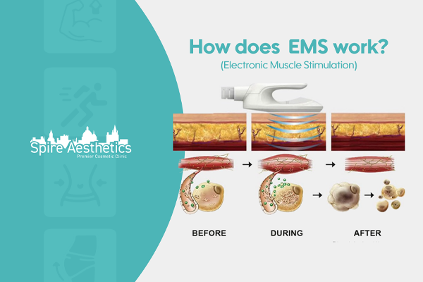EMS treatment for post pregnancy weight loss treatment Hungerford