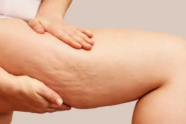Image of woman showing leg with cellulite Hungerford