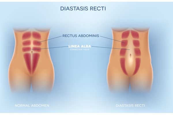 What Non-Surgical Options Are Available for Diastasis Recti Hungerford?