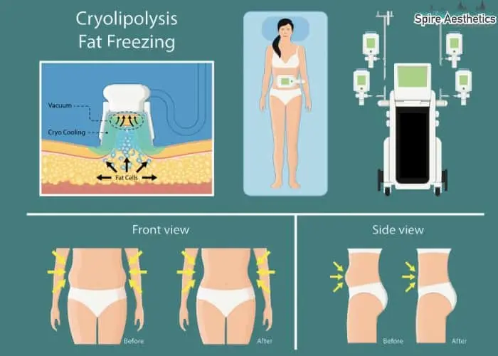 Fat freezing treatment Hungerford benefits for competitions to remove stubborn fat deposits.