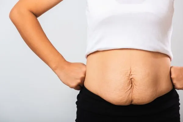 Image of a woman's stomach after weight loss with sagging skin following a gastric band Hungerford