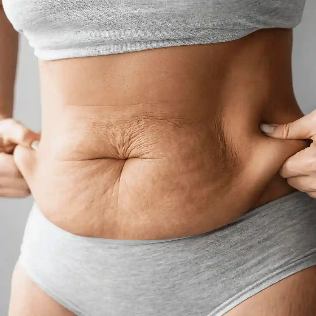 Is It Normal to Have Loose Skin After Pregnancy Hungerford?