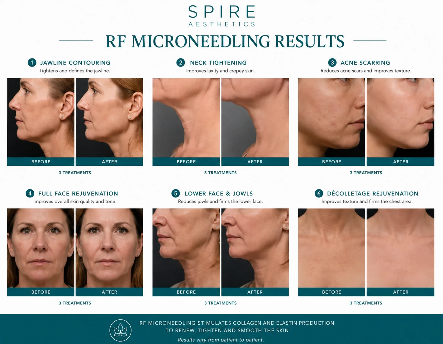 RF Microneedling Skin tightening Hungerford results