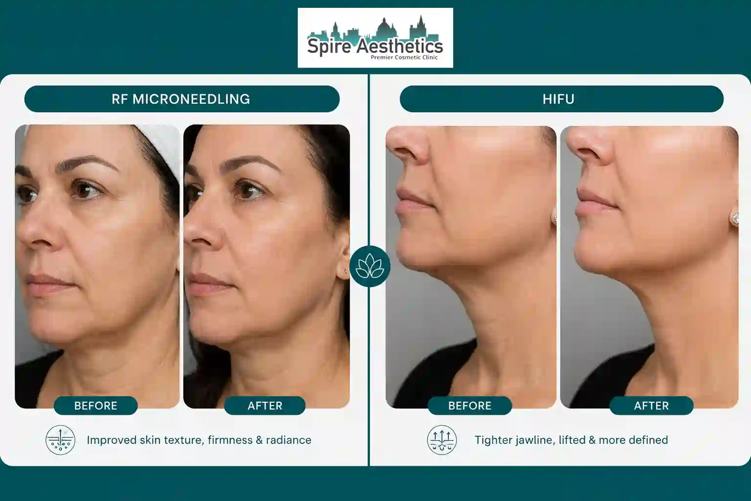Can RF Microneedling and HIFU Be Combined Hungerford?