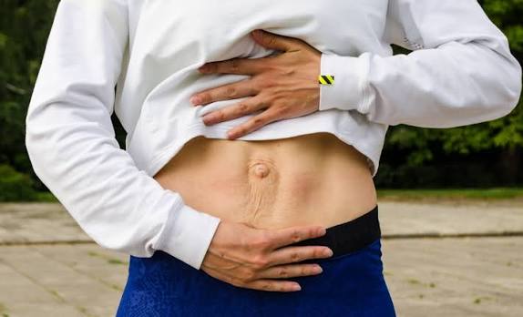 When Could Diastasis Recti Be the Missing Piece of the Puzzle Hungerford?
