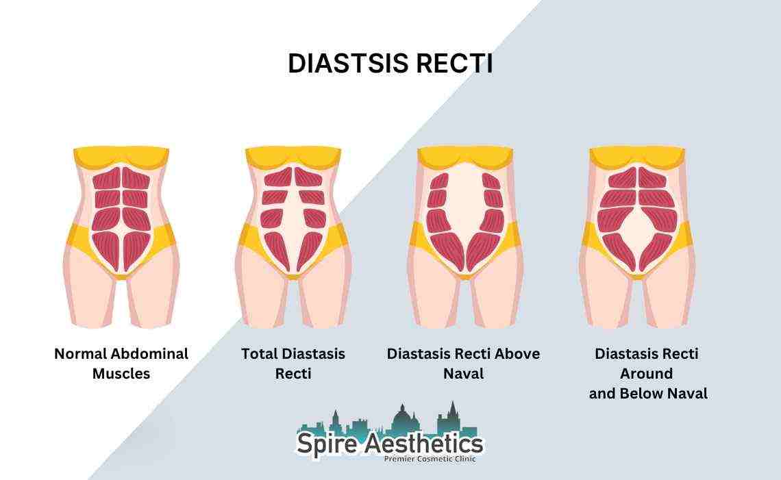 Is Non-Surgical Diastasis Recti Treatment Right for You? Common Concerns Answered Hungerford